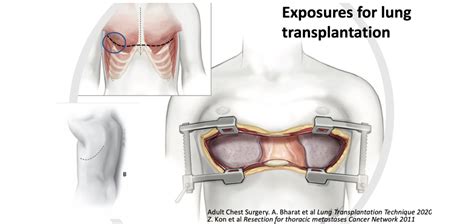 Lung Transplant Surgery | Baylor Medicine