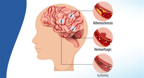 What Are the Symptoms of Brain Stroke