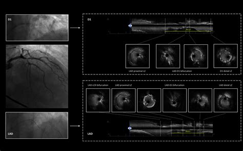 Real Time Intravascular Ultrasound Guidance For Ultra Low Contrast