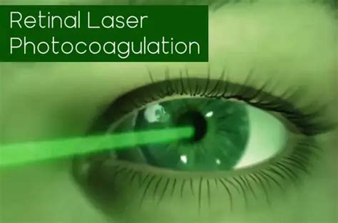 Retinal Laser Photocoagulation Purpose Procedure Risks