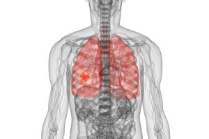 Silicosis – Pneumoconiosis