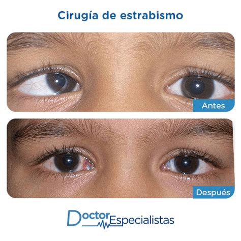 Mejores Oftalmologos Para Cirugia De Estrabismo Doctor Especialistas