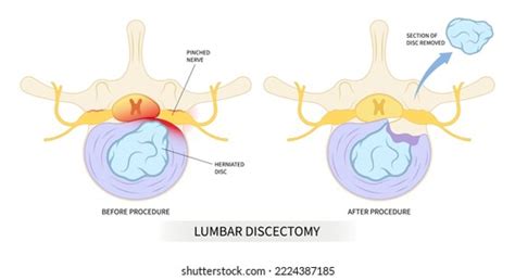 Microdiscectomy Vs Laminectomy