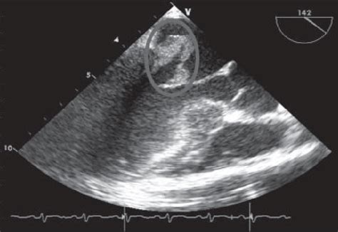 Preoperative Transesophageal Echocardiography Vegetation Was Shown To Download Scientific