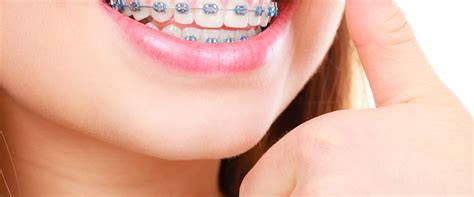 The Benefits Of Orthodontics And How To Choose The Right Orthodontic Appliances