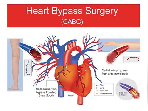 Bypass Medical Procedures And Benefits