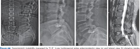 Figure 4 From Comparison Of The Early Results Of Transforaminal Lumbar Interbody Fusion And