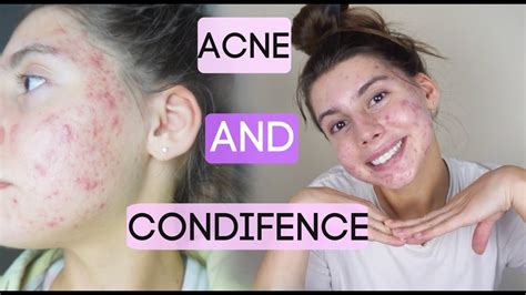 How To Be Confident With Acne My Insecurities Struggles Opening Up