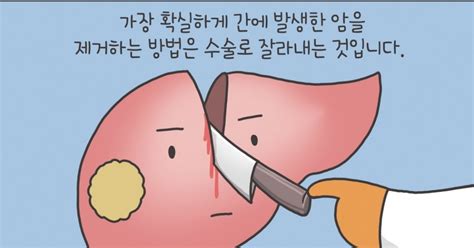 만화 그리는 의사들 〈299〉간암의 치료