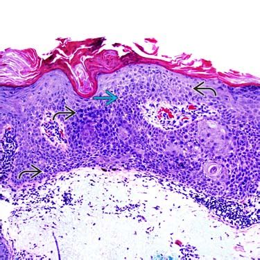 Actinic Keratosis Histology