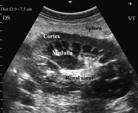 Normal Renal Ultrasound