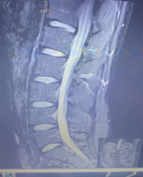 Im Making A Ml Model To Identify Herniated Bulged Discs What Is The White Pervading From The