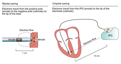 Components And Construction Of A Pacemaker The Cardiovascular