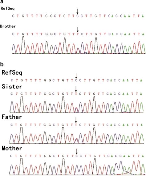 A C 7778C T P G2593E Mutation In The DNAH5 Gene In The Brother Black