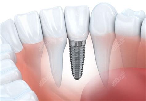 种植牙集采后种一颗牙需多少钱2023年植体集采价格表上线种植牙 8682整形网