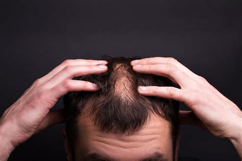 Men Hair Loss Information Chr Clinic