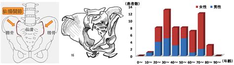 仙腸関節障害について｜日本仙腸関節研究会