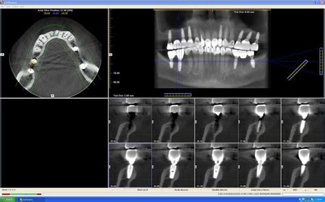 Overview Of Cone Beam Ct Radiography Vinmec