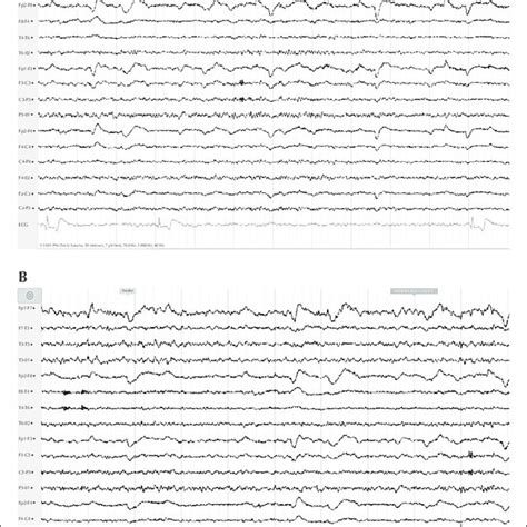 Case 2. (A) Evidence of symptomatic bradycardia based on the ECG... | Download Scientific Diagram