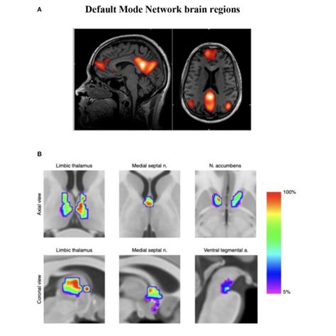 A Functional MRI Demonstration Of The Default Mode Network DMN