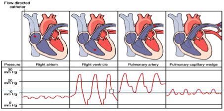 Module 2 Invasive Hemodynamic Monitoring Flashcards Quizlet