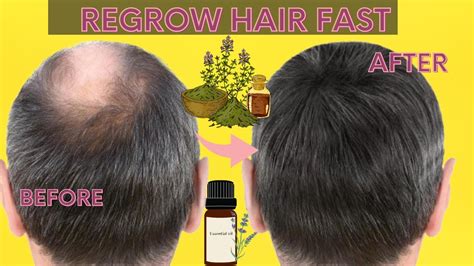 10 Proven Ways To Regrow Hair Fast Without Surgery Youtube