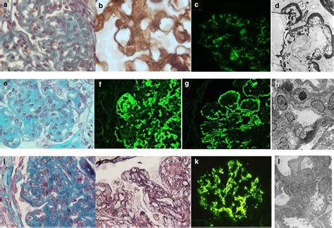 Illustrative Cases Of Dense Deposit Disease Ddd Download