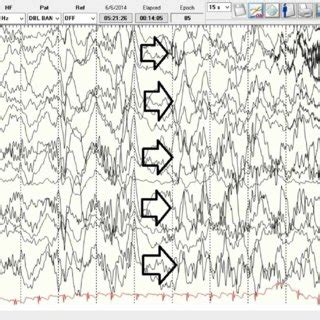 Electroencephalogram Showing Wakeful State With Bursts Of Generalized