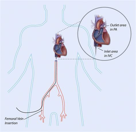 Percutaneous Ventricular Assist Device