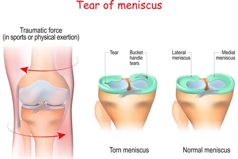 Does A Meniscus Tear Mean Surgery