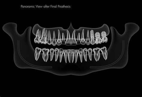 Bone Graft Swansea Sinus Lift Dental Implants Swansea