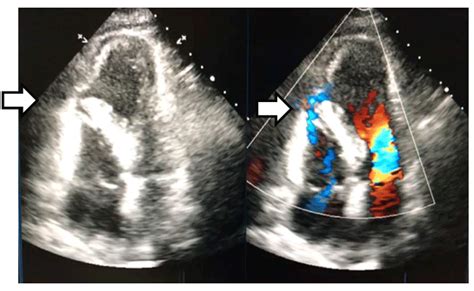 Ventricular Septal Rupture Complicating Acute Myocardial Infarction