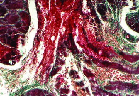 Hemorrhages In The Mucosal Membrane Of The Urinary Bladder Masson X