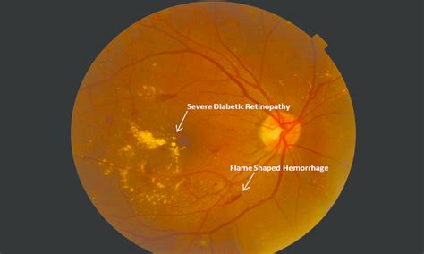 Severe Nonproliferative Diabetic Retinopathy