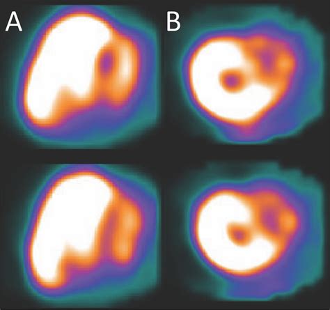 Myocardial Perfusion Imaging Performed With Technetium M In Short A