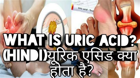 Uricacid What Is Uric Acid यूरिक एसिड क्या होता है Hindi Youtube