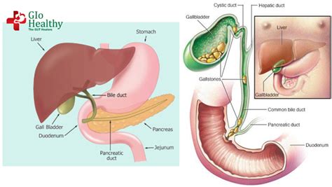 Laparoscopic Cholecystectomy | Minimally Invasive Cholecystectomy