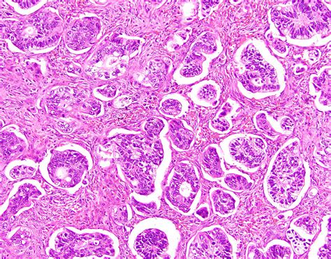 Pathology Outlines Micropapillary Carcinoma