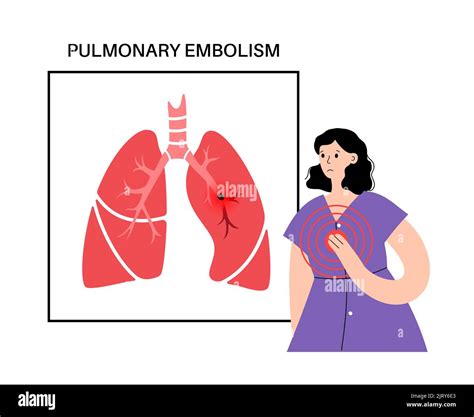 Pulmonary Embolism Illustration Stock Photo Alamy