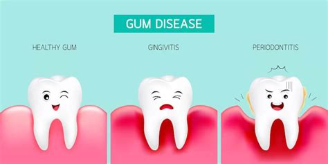 Different Stages Of Gum Disease Prestige Periodontal And Implant Center