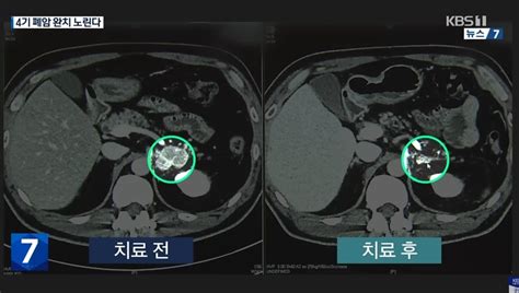 폐암 4기 완치 가능한 방사선 기술 너무도 놀라운 내용 공개됐다 포스트쉐어