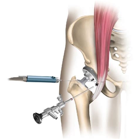 Total Hip Arthroplasty Anteroposterior Radiograph Postoperative