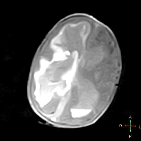 Germinal Matrix Brain Anatomy