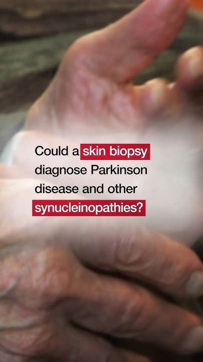 Skin Biopsy Detection Of Phosphorylated α Synuclein In Patients With Synucleinopathies Youtube