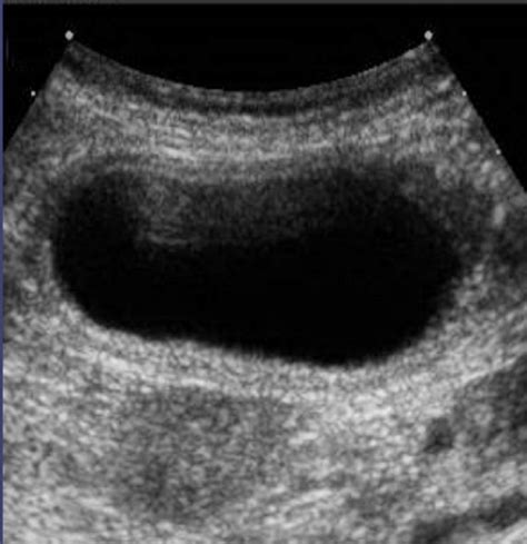 Acute Gallbladder Torsion A Continued Pre Operative Diagnostic Dilemma World Journal Of