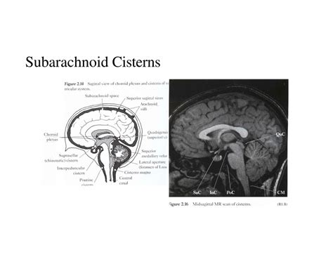 Ppt Brain Meninges Ventricles And Csf Powerpoint Presentation Free