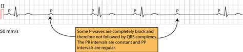 Second Degree Heart Block Ekg