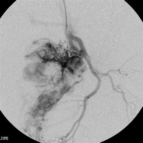 Pdf Transcatheter Artery Embolization For Postoperative Haemorrhage