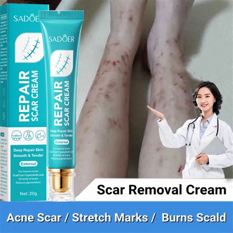 20g Scar Repair Cream For Old Scar On Leg Stretch Mark Remover Acne