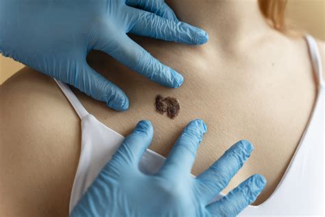Lunares malignos o melanoma ¿Cómo identificarlos y tratarlos? - Blog